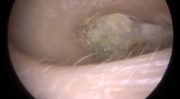 Il tappo di cerume gigante rimosso dallo specialista: "C'è voluto il doppio del tempo normale" Video