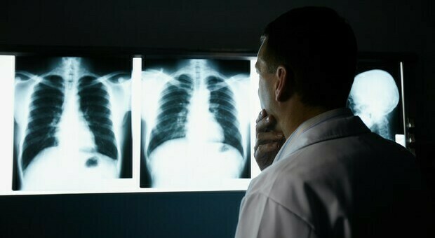Tumore al polmone, l'anticorpo monoclonale allunga la sopravvivenza