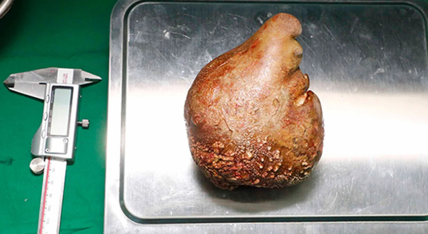 Il calcolo renale più grande del mondo rimosso in Sri Lanka: è grande quanto un pompelmo