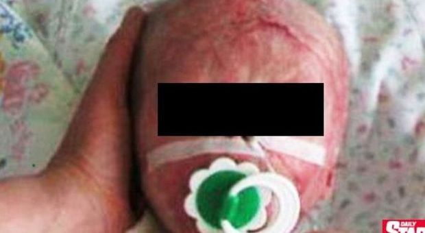 Neonato ustionato e sfigurato dall'incubatrice: ​ha 3 giorni di vita. E i genitori lo abbandonano