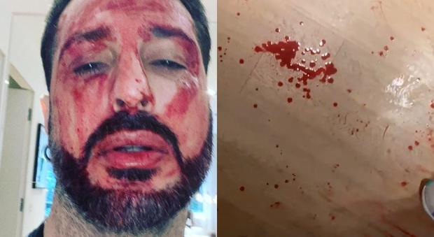 Fabrizio Corona choc: la foto e i video con il volto e il corpo pieni di sangue. «Mi taglio la vita»