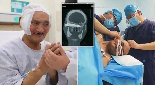 Coltello arrugginito rimosso dalla testa di un uomo che è stato pugnalato 26 anni fa