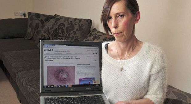 Scopre di avere il cancro alla pelle grazie a Google: "Per i medici era soltanto un'irritazione"