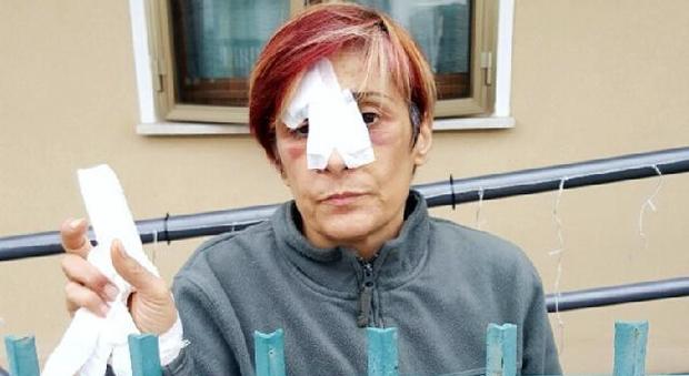 Donna aggredita al volto dal dogo argentino per salvare il suo bassotto