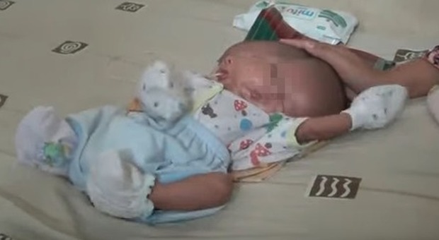 Il bimbo nasce con due volti e due cervelli, i genitori disperati: «I medici ci avevano detto che aveva la testa un po' grossa» (frame Youtube)