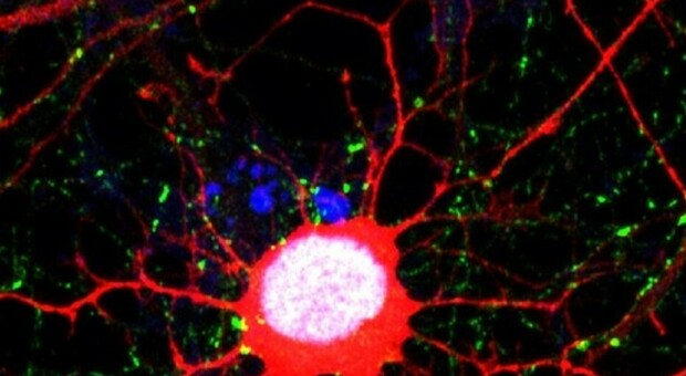 Glioblastoma, svelato "l'inganno" del tumore al cervello più aggressivo e pericoloso: «La chiave in un enzima»