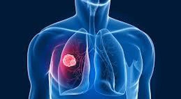 Cancro al polmone: cura senza la chemio