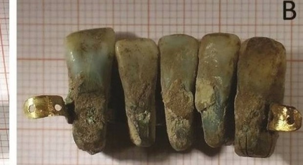 La dentiera di quattro secoli fa ritrovata a Lucca