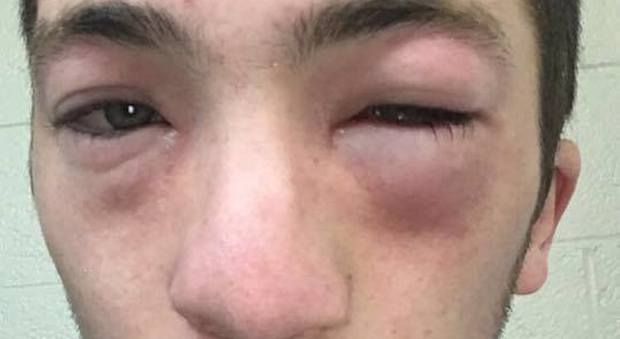 Bulli spalmano il burro di arachidi sulla sua faccia, ma è allergico: studente rischia la vita