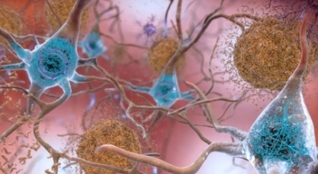 Alzheimer, scoperta forma di demenza che «imita» la malattia: in molti casi cure errate