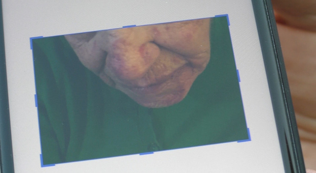 Anziana rapinata a Napoli, due mesi con una lama nel collo