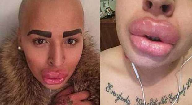 200mila euro per somigliare a Kim Kardashian: "Non riesco più a muovere le labbra"