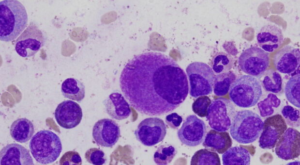 Tumori, nuovo farmaco per la leucemia mieloide cronica. «Efficacia raddoppiata»