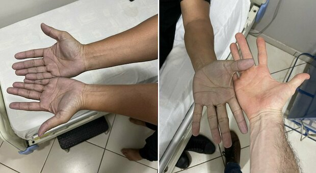 Paziente in ospedale con le mani blu, il medico: «Mai visto un caso del genere». La diagnosi ha dell'incredibile