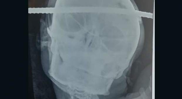 Sbarra d'acciaio conficcata nel cranio, operaio 21enne vivo per miracolo