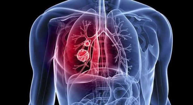 Tumore ai polmoni, con la nuova terapia una qualità della vita migliore