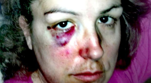 La consigliera comunale pubblica la sua foto con occhio nero e labbro sanguinante: «Donne, denunciate»