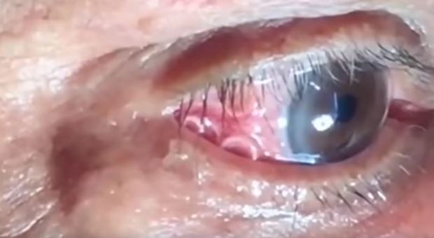 Avverte un fastidio all'occhio, i medici scoprono un verme lungo 15 centimetri