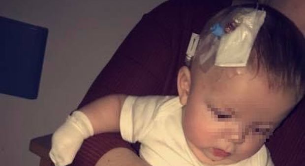 Neonato di 4 settimane rischia di morire per il bacio di un parente: cosa è successo
