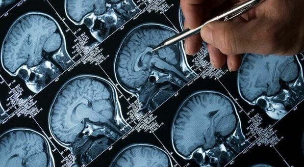 Alzheimer, mancanza sonno aumenta rischi patologia: ecco perché. Insonnia favorisce processi neurodegenerativi
