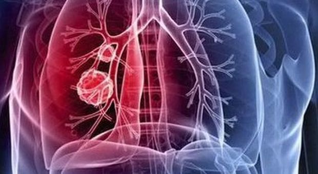Giordano: «Carcinoma polmonare, nuove cure con l'immunoterapia»
