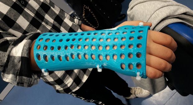 Braccio fratturato, addio al gesso: parte la sperimentazione Santobono ai bimbi tutori personalizzati in 3D