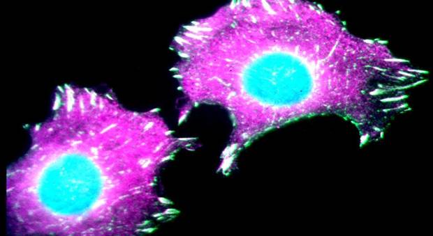 Cancro, lo studio: "Virus modificati per combattere le cellule tumorali"