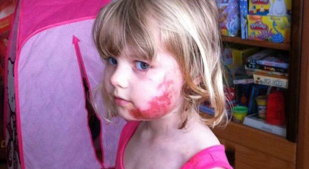 Daisy, 4 anni, ustionata gravemente sull'aereo