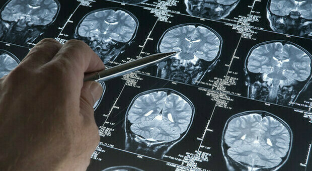 Tumore al cervello, una microscopica sarà in grado di "catturare" la massa tumorale