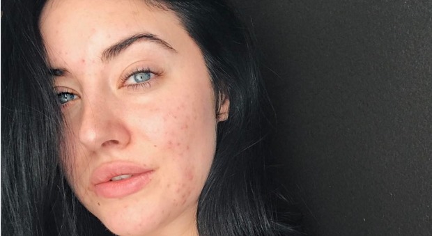 La modella con l'acne conquista Instagram: "Provo ad amare il mio corpo così com'è"