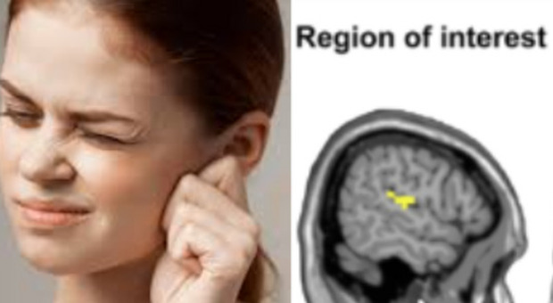 Acufene, 750 milioni di persone soffrono del disturbo: presentato lo studio dell'Università Tor Vergata per il trattamento del «tinnitus»