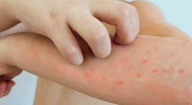 Casi di varicella nelle scuole di Volpago del Montello
