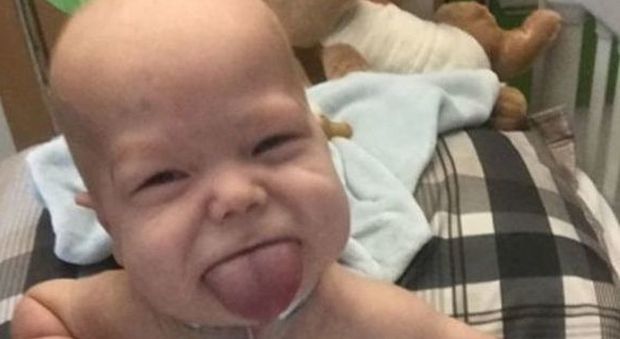 Il bimbo con la lingua che non smette di crescere: operato per poter mangiare e respirare