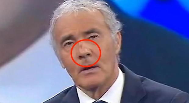 Massimo Giletti, volto tumefatto in diretta: «Ho il naso rotto». Mistero a Non è l'Arena