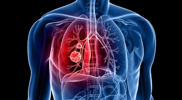 Cancro al polmone metastatico, il nuovo farmaco: 49% di risposta obiettiva e 93% di tasso di controllo della malattia