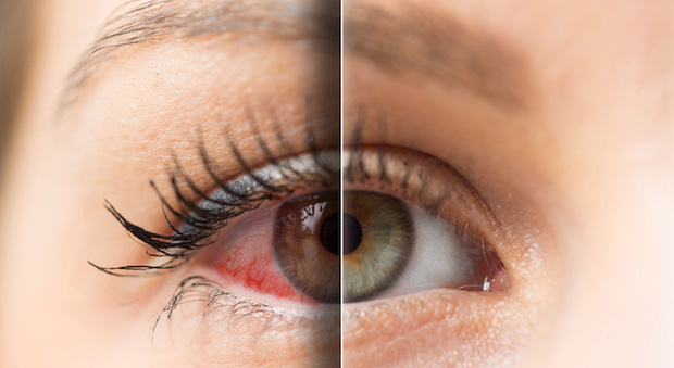 Oculistica, l’allarme: «In aumento i casi di “dry eye” per chi passa ore davanti a smartphone e pc»