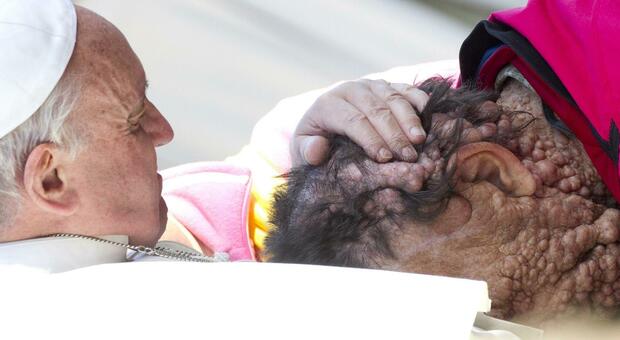 Morto Vincenzo Riva: venne abbracciato dal Papa, aveva il volto deturpato dal morbo di von Recklinghausen FOTO