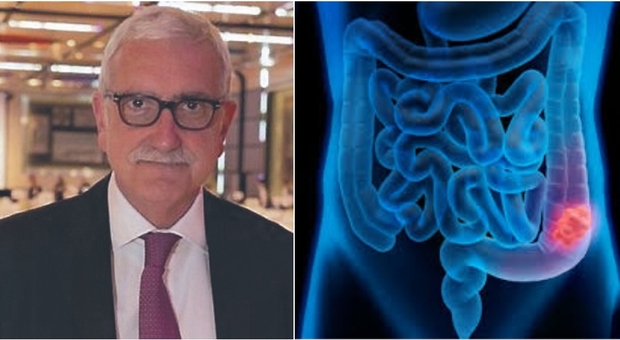Tumori gastrointestinali, l'oncologo Francesco Cognetti: «Attenzione ai sintomi come gonfiore addominale e sanguinamento»