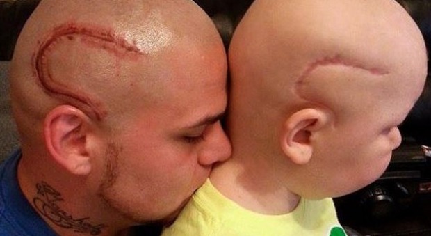 Usa, addio al piccolo Gabe: il padre si fece tatuare sulla testa una cicatrice identica alla sua