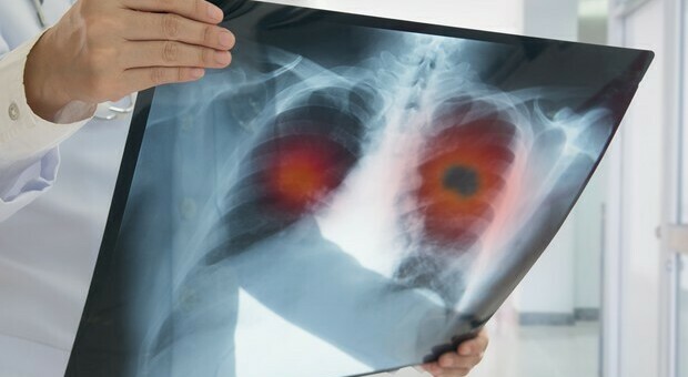 Tumore al polmone, scoperti quattro sottotipi di adenocarcinoma: la ricerca italiana