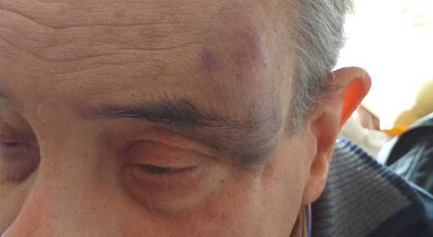 Napoli, anziano va al Policlinico Federico II e cade sulla pavimentazione dissestata