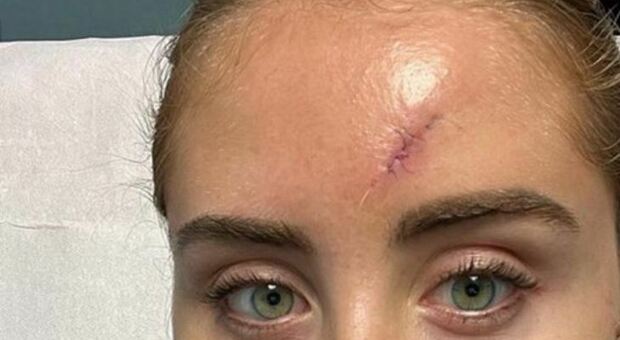 Intervento chirurgico fatto: Valentina Ferragni mostra la cicatrice sulla fronte dopo l’operazione