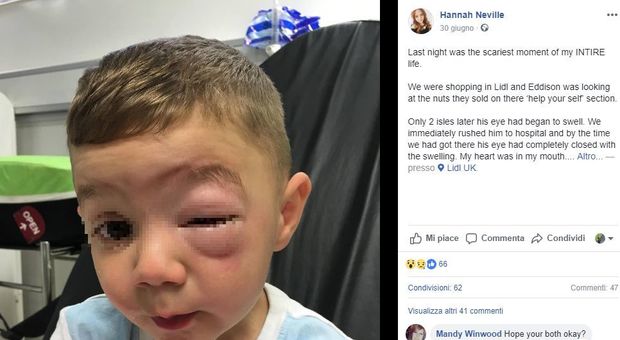 Il pacchetto di noccioline è chiuso male, bambino di 2 anni ha una grave reazione allergica