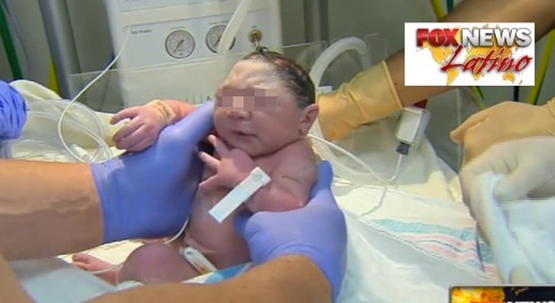 Zika, nata la prima bimba con microcefalia