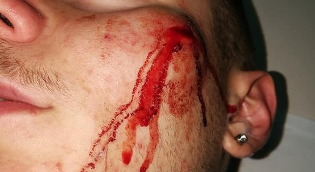 Napoli, picchiato e rapinato da baby gang: quattro punti di sutura per un 16enne. La madre pubblica le foto su Fb
