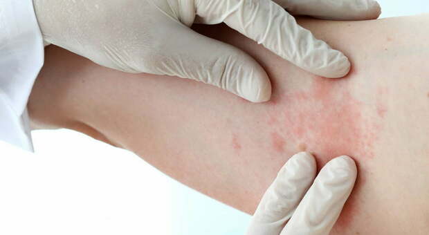 Giornata di screening per la dermatite