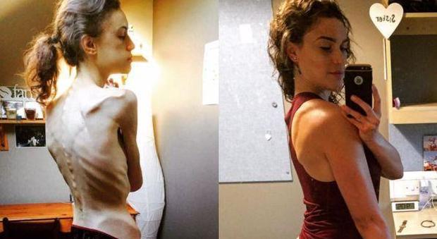 "Instagram mi ha salvato la vita": la storia di una 20enne vittima dell'anoressia