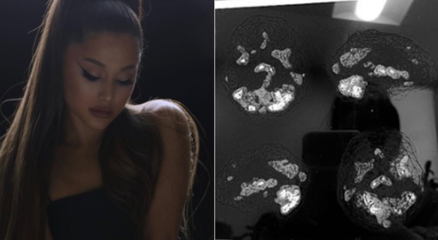 Ariana Grande e la radiografia choc al cervello dopo l'attentato di Manchester