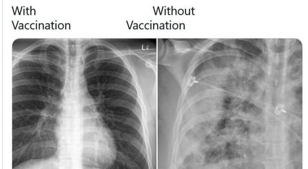 Covid, gli effetti sui polmoni su è vaccinato e chi no: il confronto
