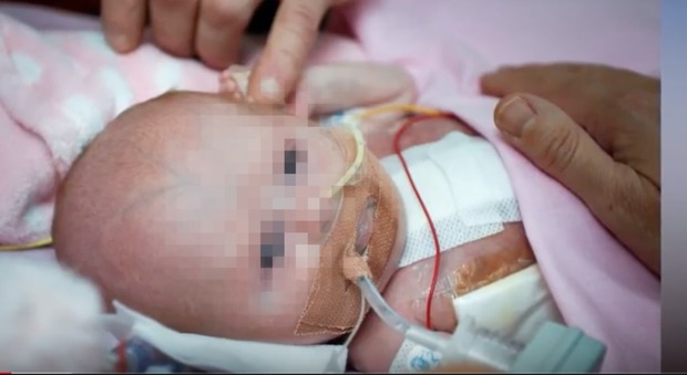 Bimba nasce con il cuore fuori dal petto: la favola di Hope, salvata dopo 3 interventi chirurgichi
